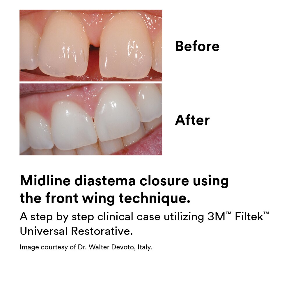 Filtek Universal Essential Capsule Kit thumbnail 7