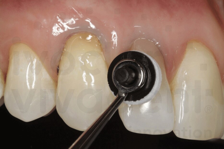 OptraSculpt Pad, Refill, 4 mm, 60/Pk, 639792 product image