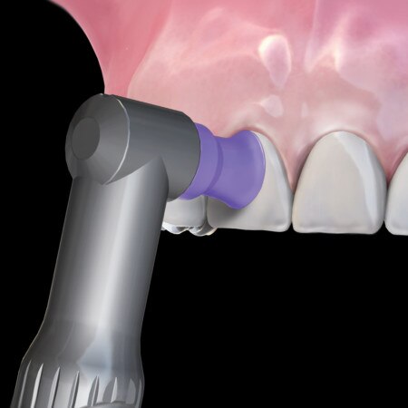 Hu-Friedy Prophy Angle Soft Purple Latex-Free 100/Bx thumbnail 8