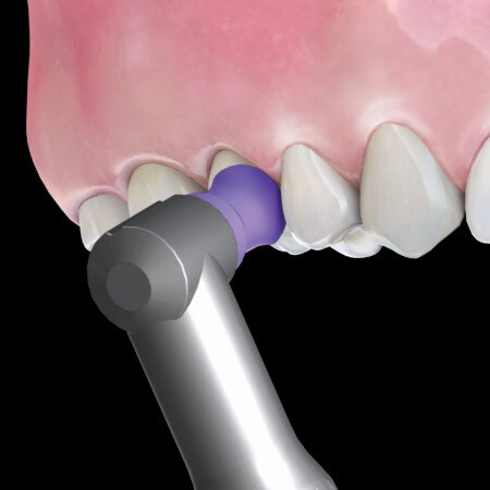 Hu-Friedy Prophy Angle Soft Purple Latex-Free 100/Bx thumbnail 13