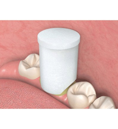 Traxodent Retraction Caps, # 5, Large, 60/Pk, 9048255 thumbnail 10